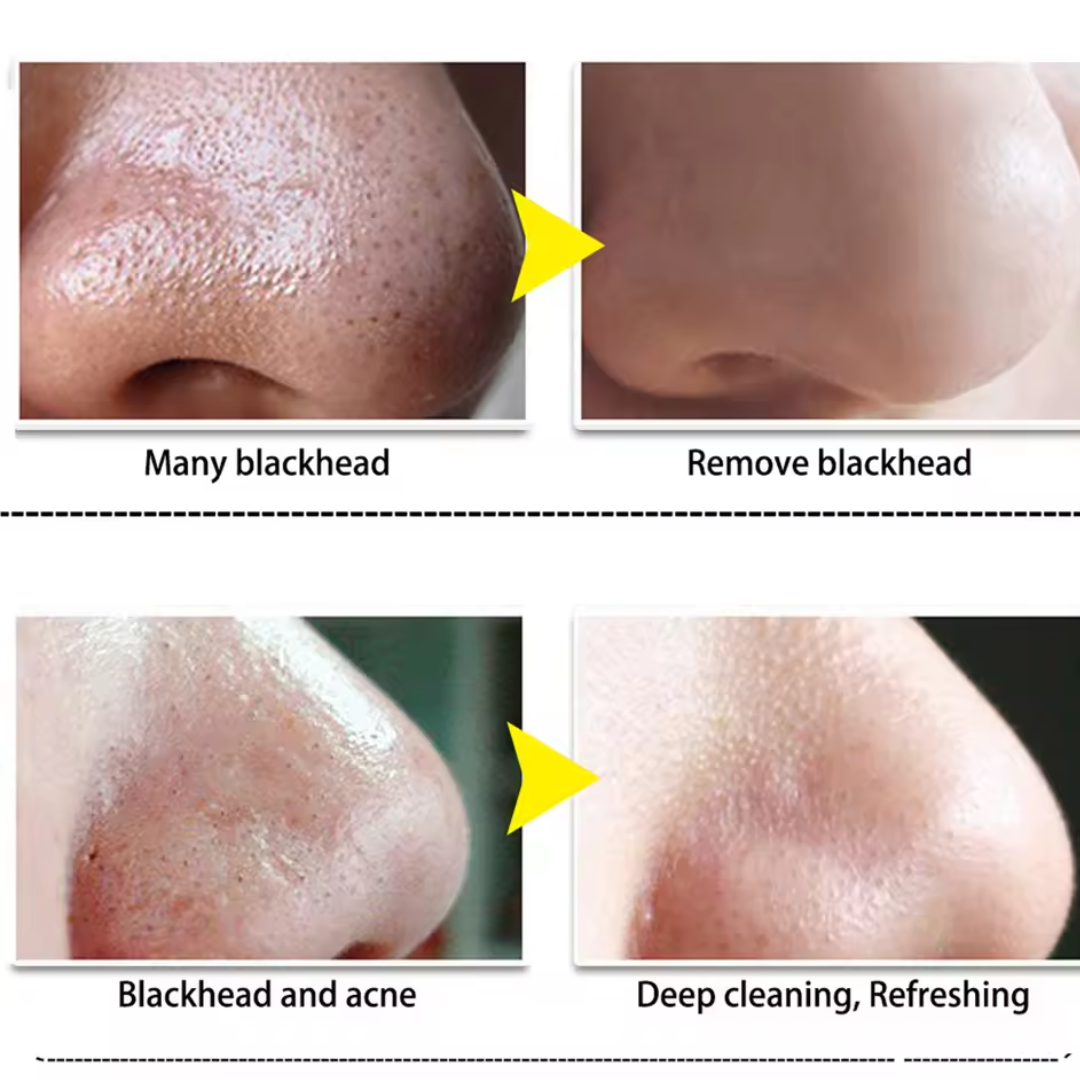 BLACKHEAD REMOVER LANBENA